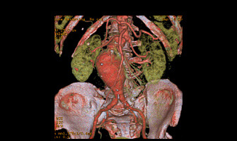 画像症例：腹部大動脈瘤